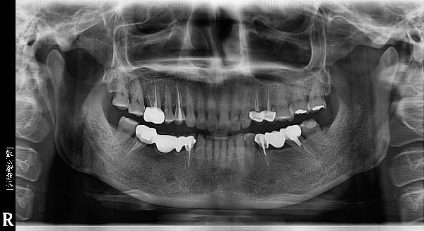 就以前的觀念，缺牙？！那當然就是直覺做傳統假牙，傳統假牙需要磨掉旁邊健康牙齒當支柱，隱藏在牙套裡的健康牙齒也因此不易清潔而導致嚴重蛀牙，20年的傳統假牙已不復使用，再加上多種飲食上的疼痛與不便，決定採用可單顆植牙的人工植牙方式解決所有問題，更因年紀使齒槽骨萎縮，藉由補骨技術，讓人工植牙後牙齒更穩固。