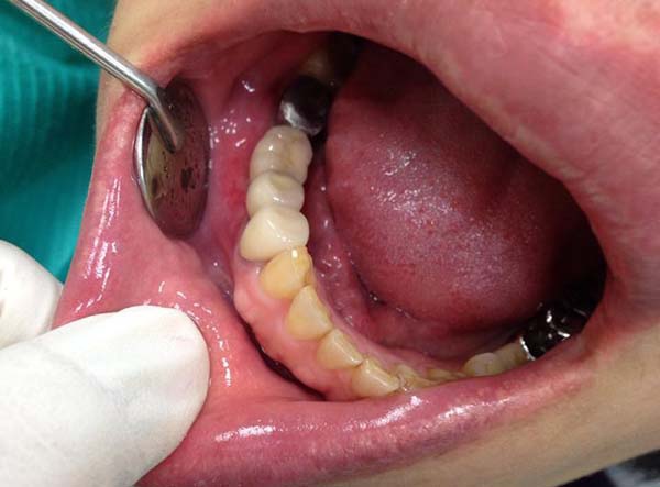 套上假牙之後，與健康的牙齒非常的相似，而且單顆的假牙牙套，與穩固的植體支柱，更像自然牙齒一樣的咬合與使用。