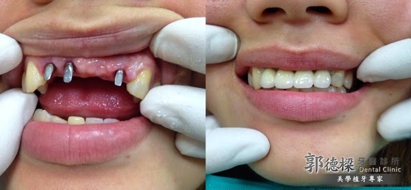 經過一再的回診植入植體→套上假牙套後，健全的齒列完成囉！