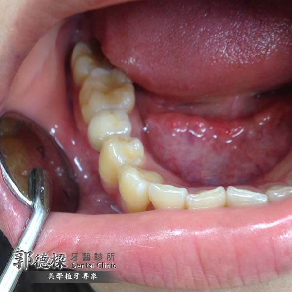 定期口腔檢查，及早治療牙齒問題，人工植牙提高生活便利性