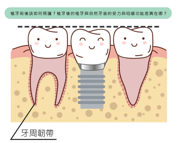 植牙術後該如何照護？植牙後的植牙與自然牙齒的受力與咀嚼功能差異在哪？