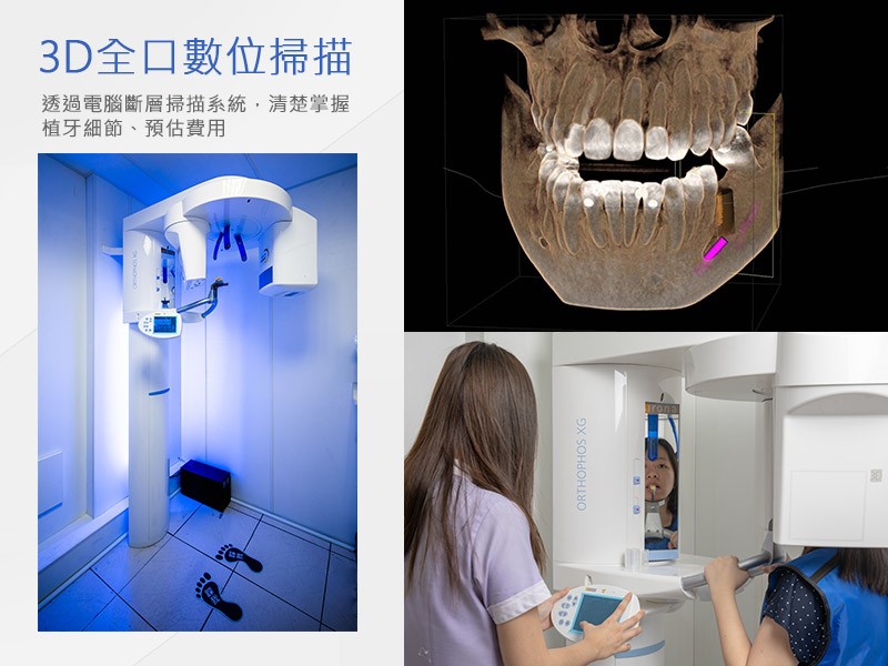 3D全口數位掃描│透過電腦斷層掃描系統，清楚掌握植牙細節、預估費用